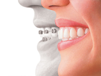 Mansfield Family Dentistry | Dental Fillings, Teeth Whitening and Inlays  amp  Onlays