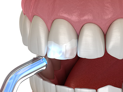 Mansfield Family Dentistry | Extractions, Dental Bonding and Inlays  amp  Onlays