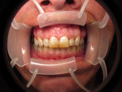 Mansfield Family Dentistry | Dental Fillings, Root Canals and Dental Bonding