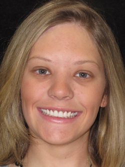 Mansfield Family Dentistry | Nitrous Oxide, Dental Bridges and Extractions