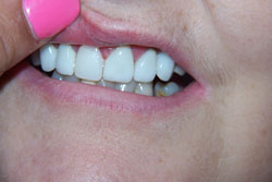 Mansfield Family Dentistry | Dental Bonding, Silent Sleep Oral Appliance and Sedation Dentistry