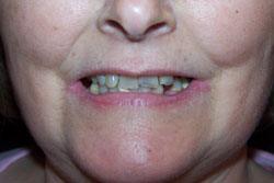 Mansfield Family Dentistry | Invisalign reg , Dentures and Cosmetic Dentistry