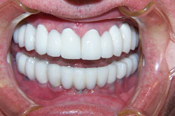 Mansfield Family Dentistry | Root Canals, Preventative Program and Emergency Treatment