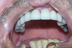 Mansfield Family Dentistry | Silent Sleep Oral Appliance, Veneers and Extractions