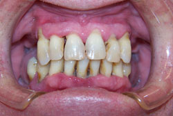 Mansfield Family Dentistry | Crowns, Dentures and Inlays amp Onlays