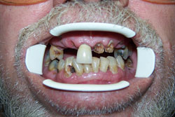 Mansfield Family Dentistry | Inlays amp Onlays, Dental Bridges and Extractions