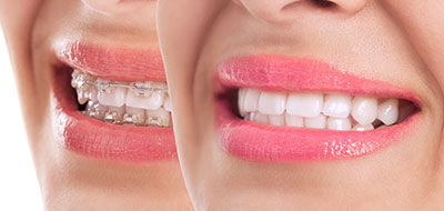 Mansfield Family Dentistry | Invisalign reg , Teeth Whitening and Crowns