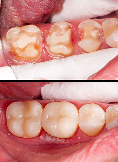 Mansfield Family Dentistry | Dentures, Preventative Program and Extractions