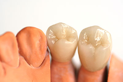 Mansfield Family Dentistry | Dental Bonding, Invisalign reg  and Dental Fillings
