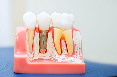 Mansfield Family Dentistry | Sedation Dentistry, Dental Fillings and Dental Bridges
