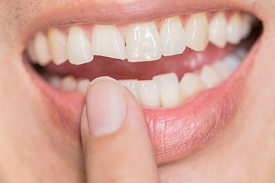 Mansfield Family Dentistry | Nitrous Oxide, Preventative Program and Dental Bridges