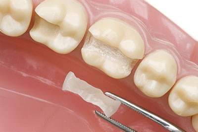 Mansfield Family Dentistry | Inlays  amp  Onlays, Dental Bridges and Dental Sealants