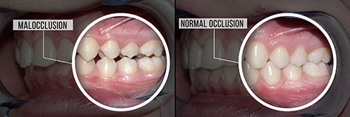 Mansfield Family Dentistry | Silent Sleep Oral Appliance, Dental Bridges and Dental Bonding