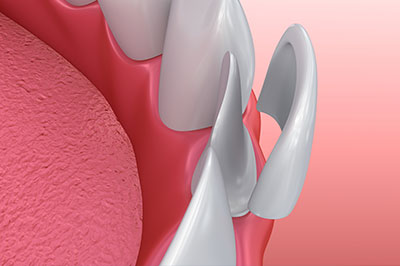 Mansfield Family Dentistry | Crowns, Root Canals and Implant Dentistry