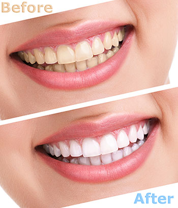 Mansfield Family Dentistry | Crowns, Silent Sleep Oral Appliance and Dental Bonding