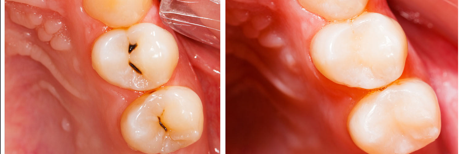 Mansfield Family Dentistry | Inlays  amp  Onlays, Silent Sleep Oral Appliance and Veneers