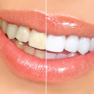 teeth whitening Mansfield TX