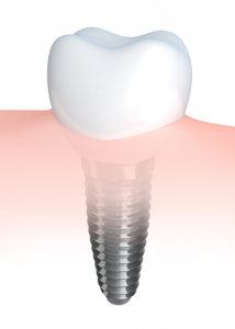 Are Dental implants worth it