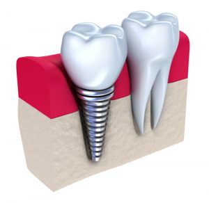 Can My Dental Implants Get Cavities